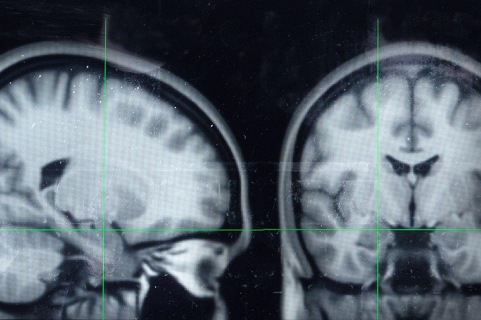 Image of two black and white brain scans 