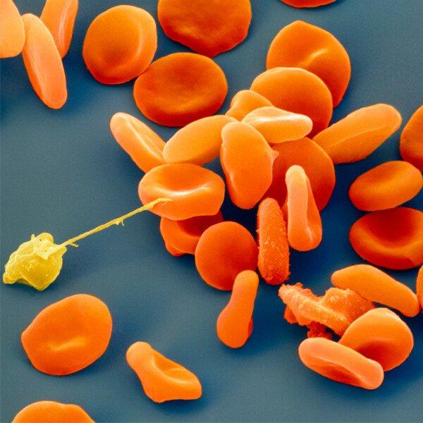 Coloured scanning electron micrograph of Plasmodium falciparum with blood cells. 