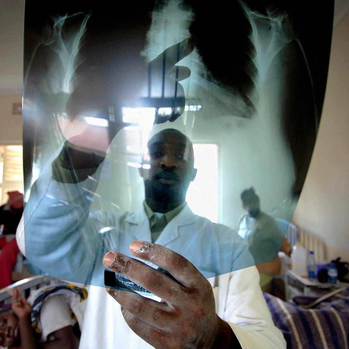 A doctor examines the x-ray of the chest of a patient with TB
